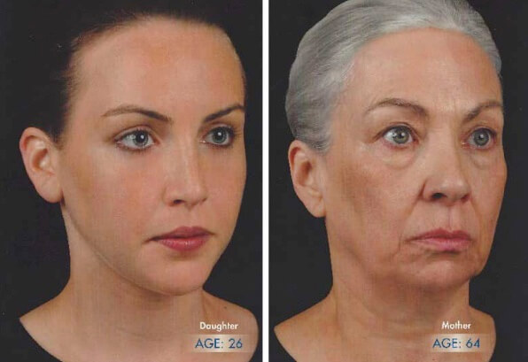 Mother-daughter comparison showing natural progression of face during the aging process.