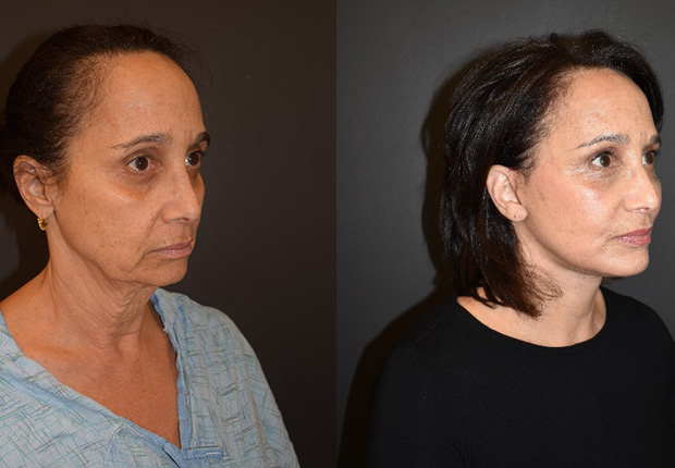 Before & after image showing the reduction in facial sagging and improved overall shape as a result of a facelift by Dr. Cross.