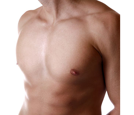 Male Breast Reduction Surgery for Gynecomastia