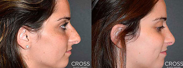 See the results before your Rhinoplasty procedure with Vectra Simulated Results.