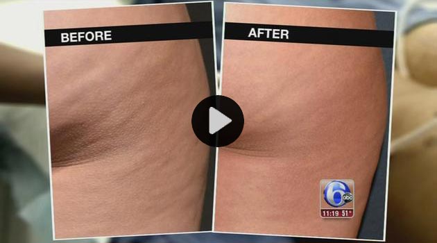 Dr. Cross Featured on ABC 6 - New procedure rids patients of unwanted cellulite