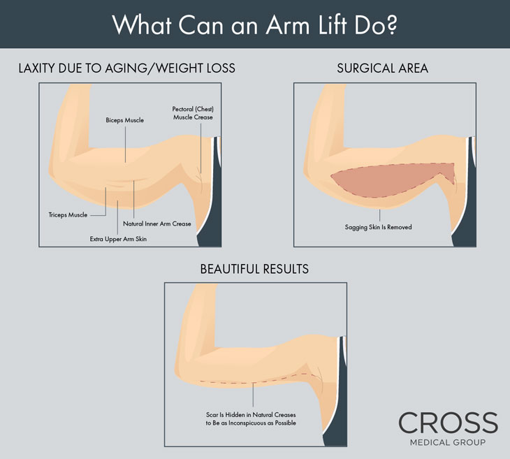 Excess skin is removed during an arm lift at the Philadelphia area’s Cross Medical Group.