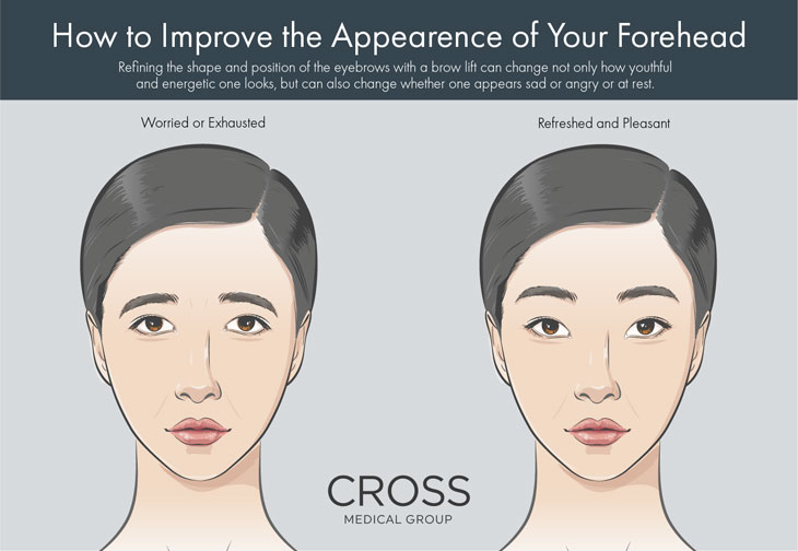 How to improve appearance of your forehead