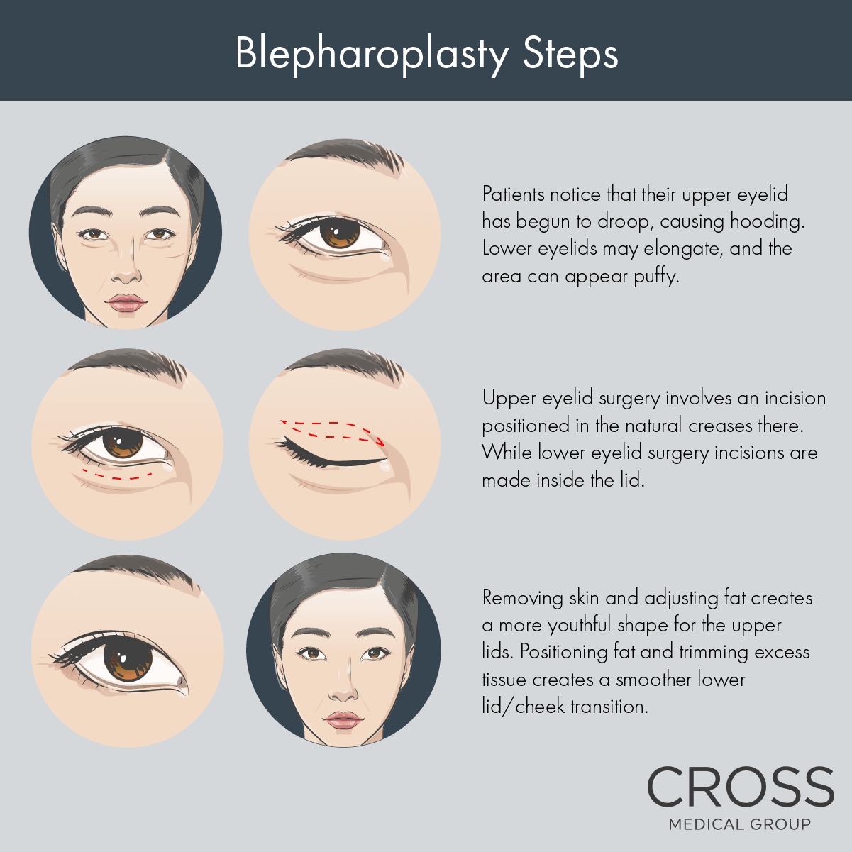 Get details about blepharoplasty at the Philadelphia area’s Cross Medical Group.