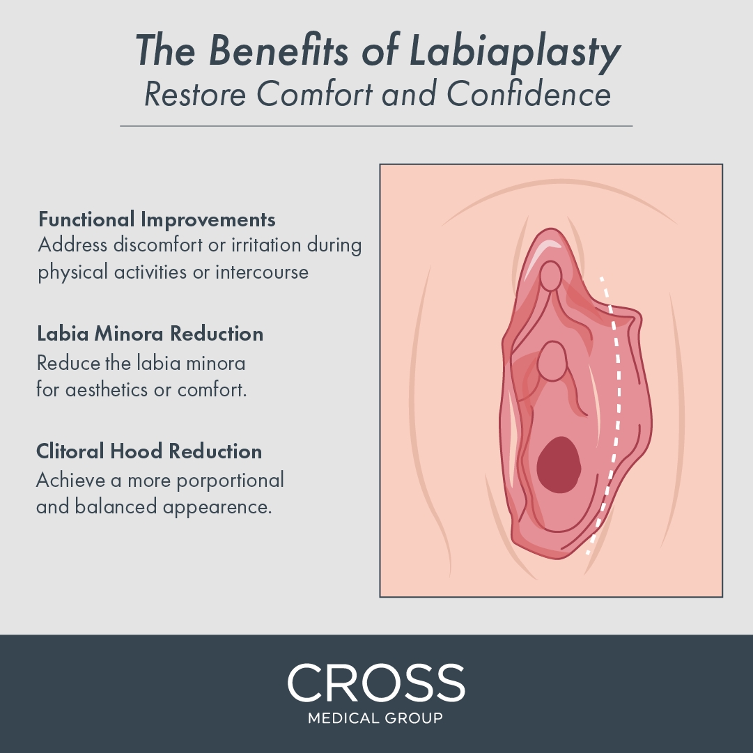 Learn the benefits of a labiaplasty at the Philadelphia area’s Cross Medical Group.