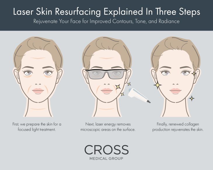 Learn the steps involved in laser skin resurfacing at the Philadelphia area's Cross Medical Group.