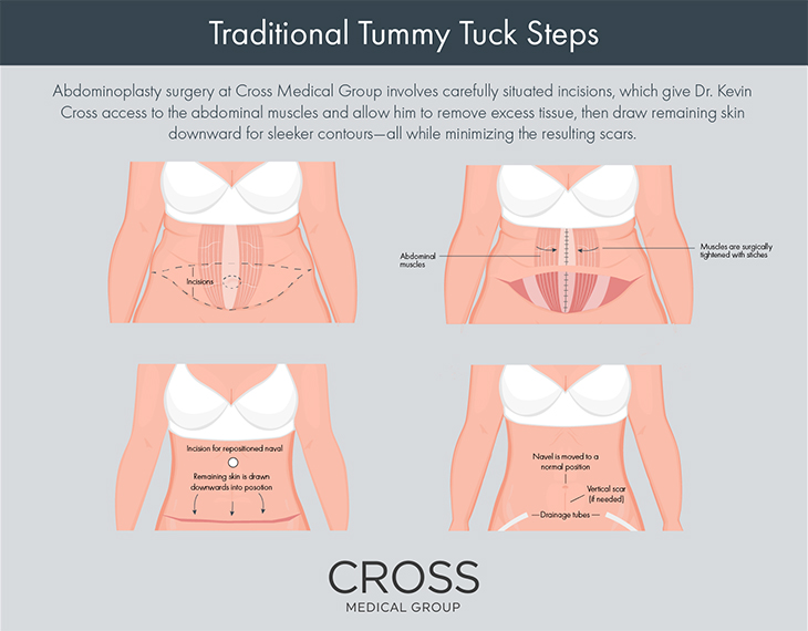 Learn what’s involved in a traditional tummy tuck at the Philadelphia area’s Cross Medical Group.