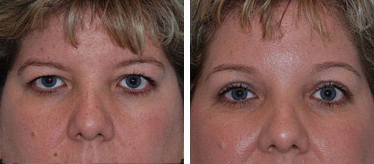 View before & after results from Cross Medical Group in Philadelphia, PA
