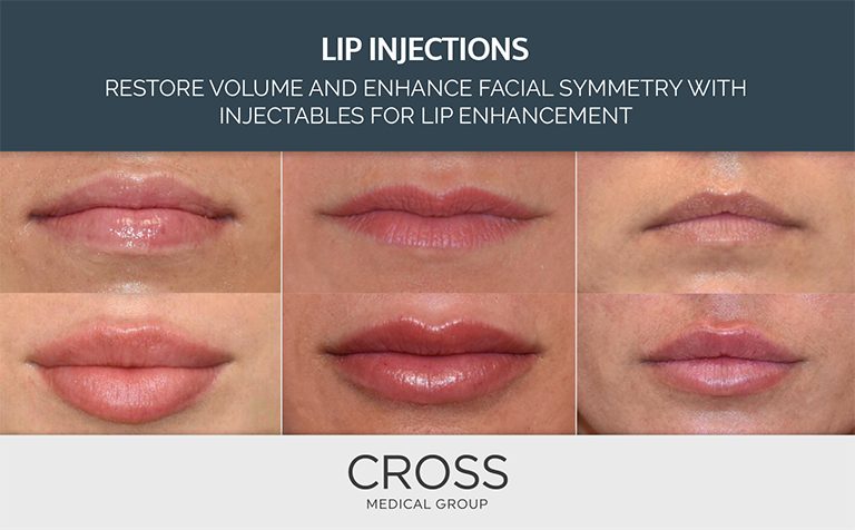 Choose from Juvederm Volbella®, Juvederm Ultra®, and Restylane® Kysse for lip injections at the Philadelphia area’s Cross Medical Group.
