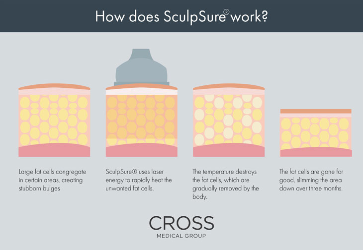 See the steps for SculpSure® at the Philadelphia area’s Cross Medical Group.