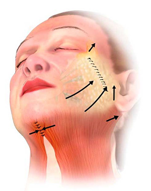 Key regions of focus during a facelift surgery.
