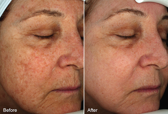 View before & after results from Cross Medical Group in Philadelphia, PA