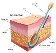 How to proceed with liposuction surgery is dependent on the location of fat cells in the body and surrounding ligaments.