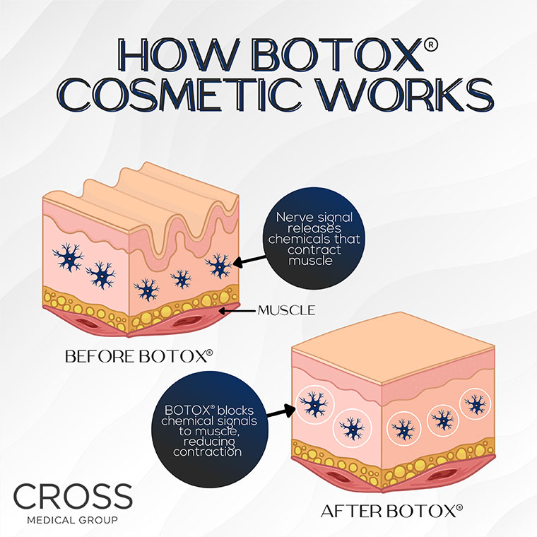 Learn how wrinkle-causing muscles react to BOTOX at Philadelphia's Cross Medical Group.