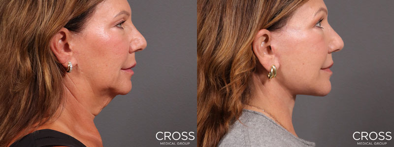 View before & after results from Cross Medical Group in Philadelphia, PA