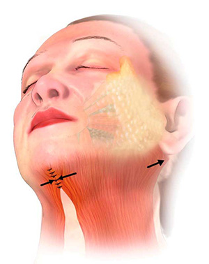 Areas where incisions are made during a neck lift surgery.