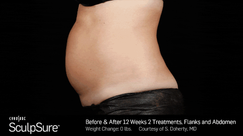SculpSure before & after results post 12 weeks with a single treatment.