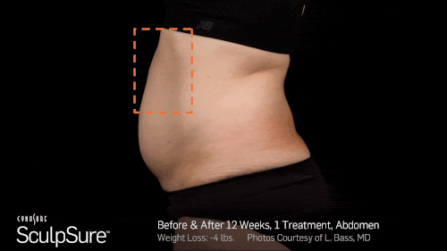SculpSure before & after results post 12 weeks with a single treatment.