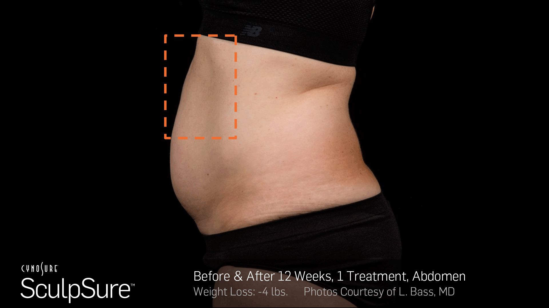 SculpSure before & after results post 12 weeks with a single treatment.