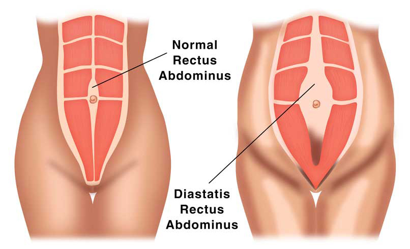 Diastasis Recti causes the ab muscles to separate, a common post-partum condition.