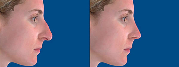 See the results before your Rhinoplasty procedure with Vectra Simulated Results.